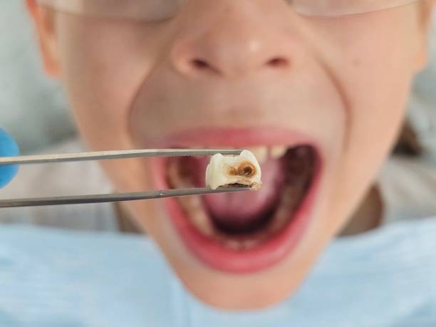 Best Emergency Wisdom Teeth Removal in Antigo, WI